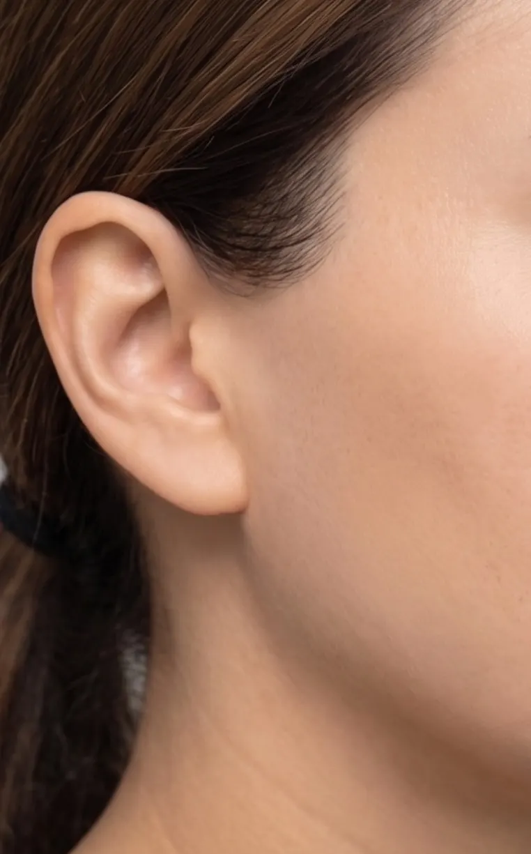 After — Laser hair removal — sideburns before and after a multi-session course